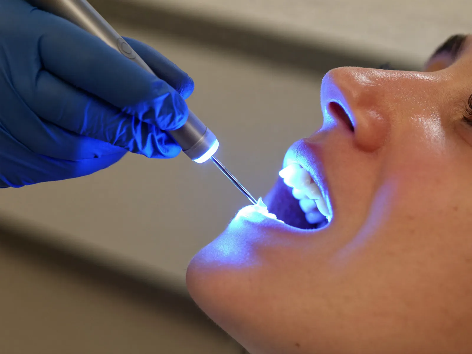 A dentist using a blue curing light during treatment